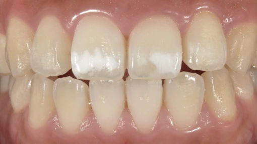 和光市　歯医者　和光市デンタルオフィス　アイコンの症例 前歯2本 治療前