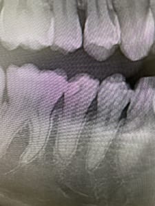 和光市　歯医者　和光市デンタルオフィス　神経に近い虫歯
