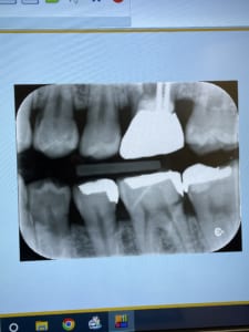 和光市　歯医者　和光市デンタルオフィス　銀歯の虫歯