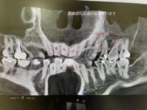 和光市　歯医者　和光市デンタルオフィス　副鼻腔