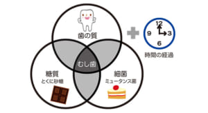 和光市　歯医者　和光市デンタルオフィス　虫歯の原因