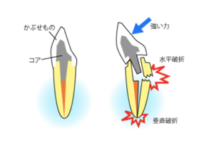 和光市　歯医者　和光市デンタルオフィス　メタルコア