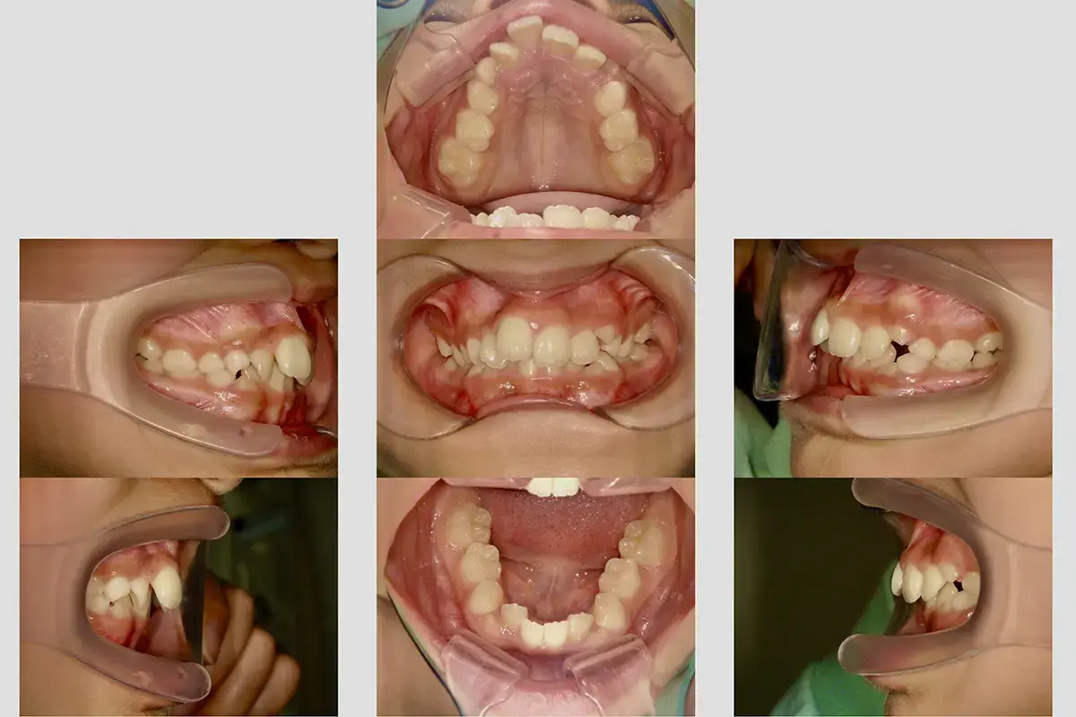 和光市　歯医者　和光市デンタルオフィス　小児矯正の症例 治療前