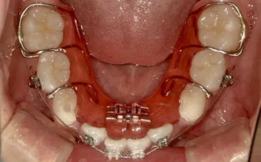 和光市　歯医者　取り外し式の拡大装置の症例 治療後