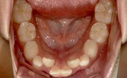 和光市　歯医者　取り外し式の拡大装置の症例 治療前