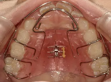 和光市　歯医者　取り外し式の「拡大装置(拡大床)