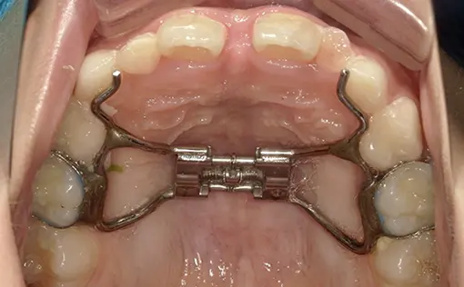 和光市　歯医者　固定式の拡大装置の症例 治療後