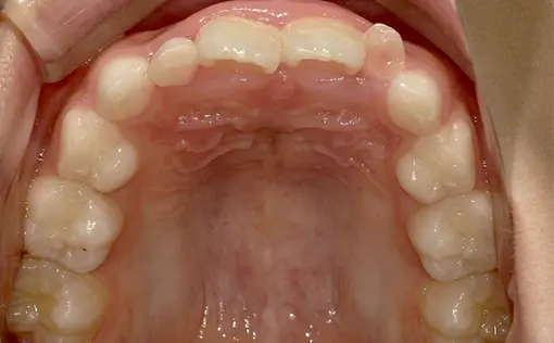 和光市　歯医者　固定式の拡大装置の症例 治療前