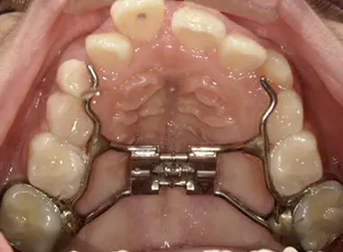 和光市　歯医者　取り外し式拡大装置　固定式の「拡大装置(急速拡大装置)