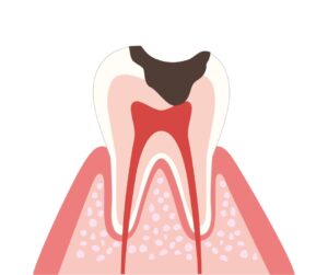 和光市　歯医者　和光市デンタルオフィス　すぐ虫歯になる