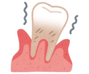 和光市　歯医者　和光市デンタルオフィス　歯を失う理由