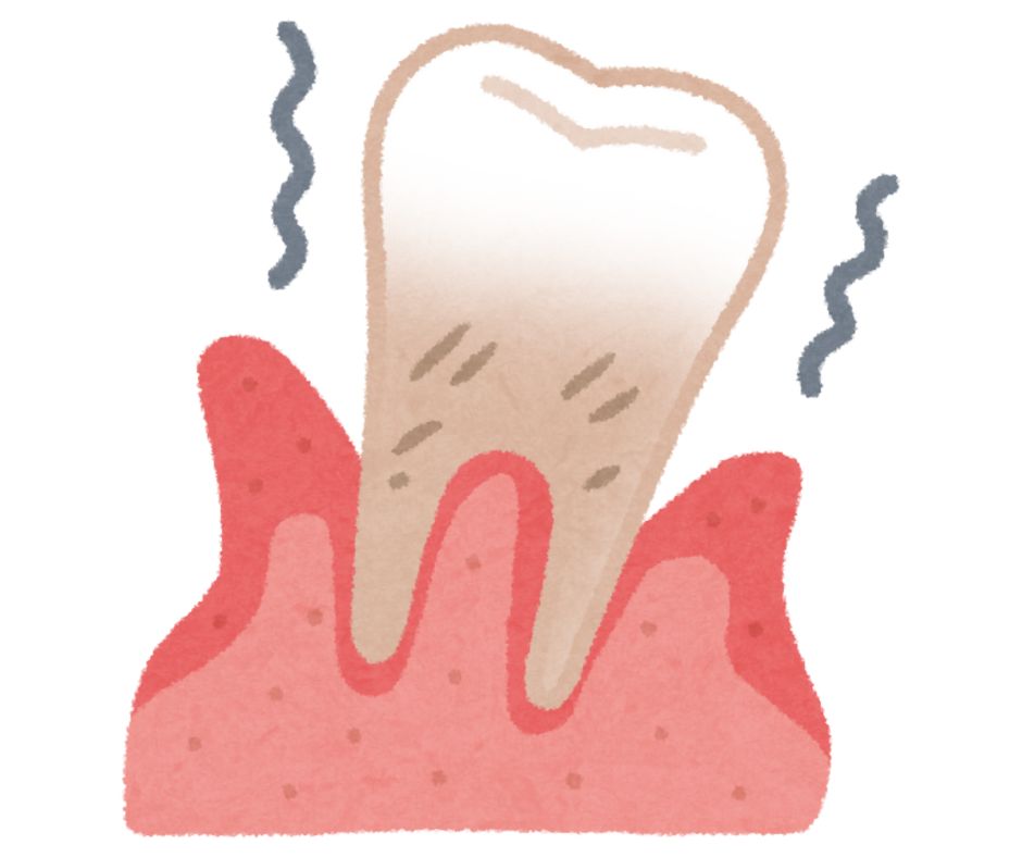 和光市　歯医者　和光市デンタルオフィス　歯を失う理由