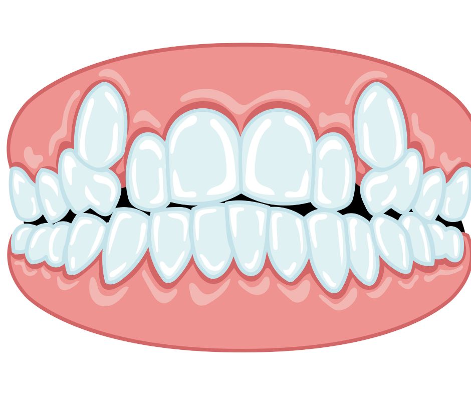 和光市　歯医者　和光市デンタルオフィス　歯を失う理由