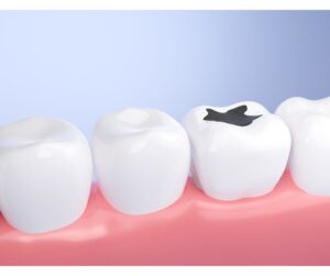 和光市　歯医者　和光市デンタルオフィス　歯を失わない予防