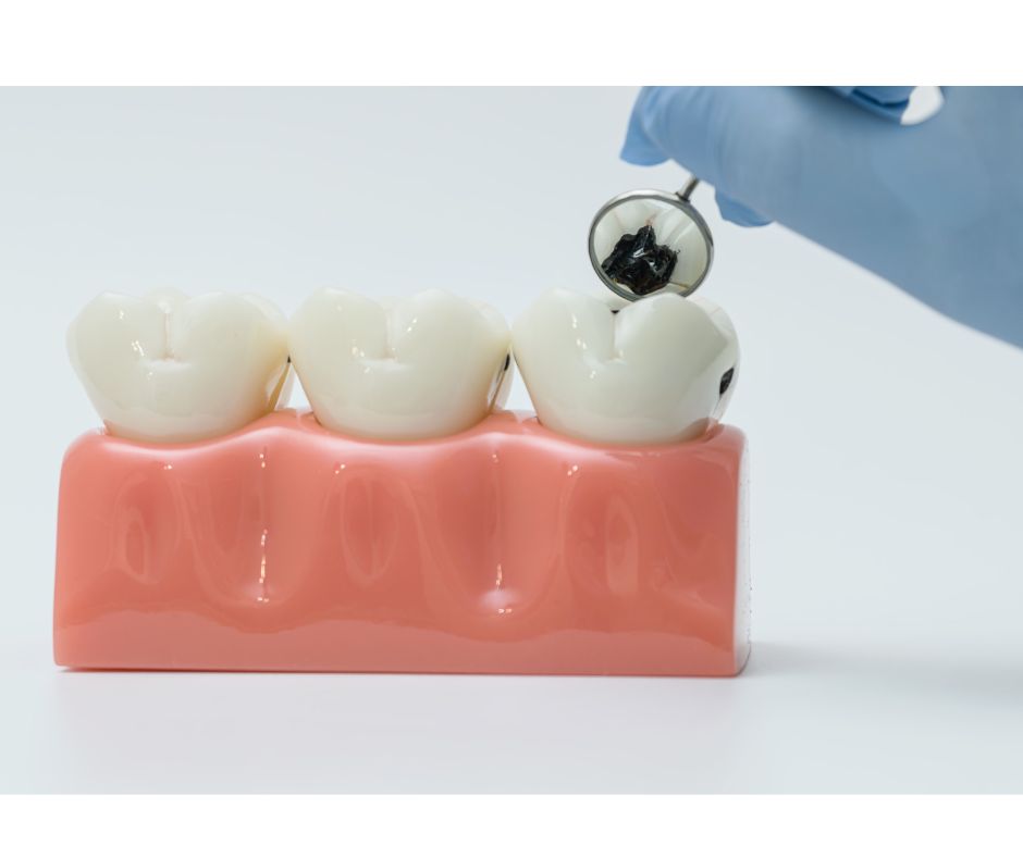 和光市 歯医者 和光市デンタルオフィス チョコレートで虫歯になる