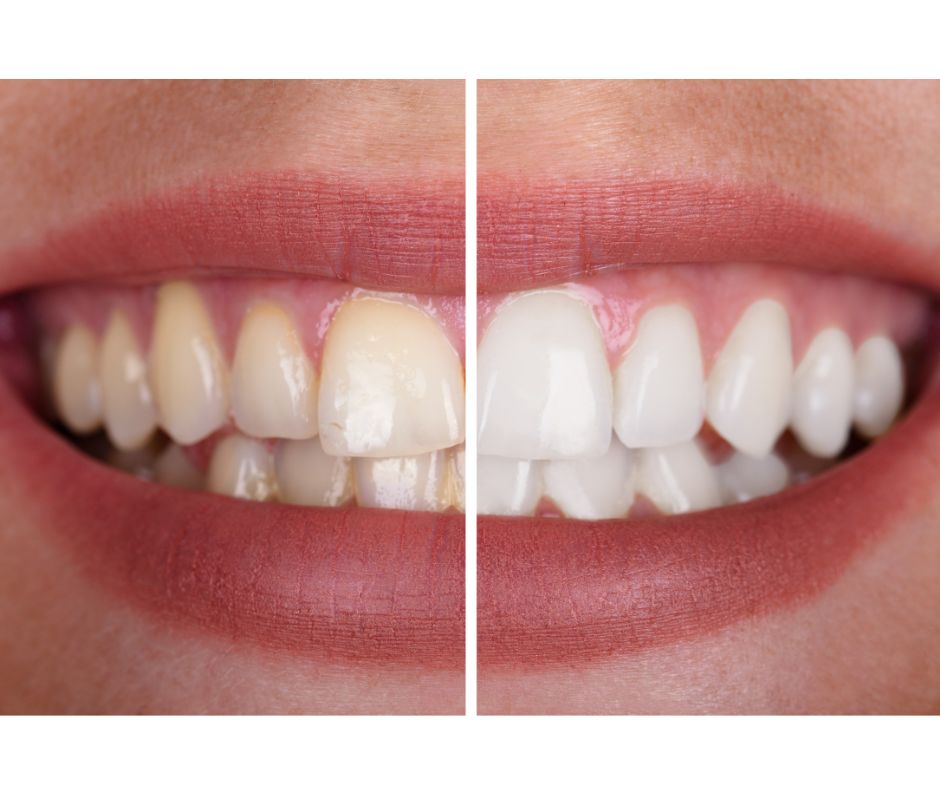 和光市 歯医者 和光市デンタルオフィス 結婚式 ホワイトニング