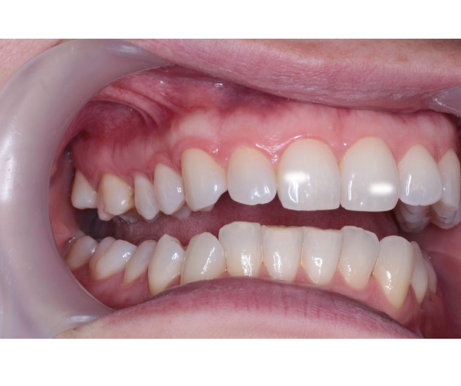 和光市 歯医者 和光市デンタルオフィス 白濁 ホワイトスポット icon治療