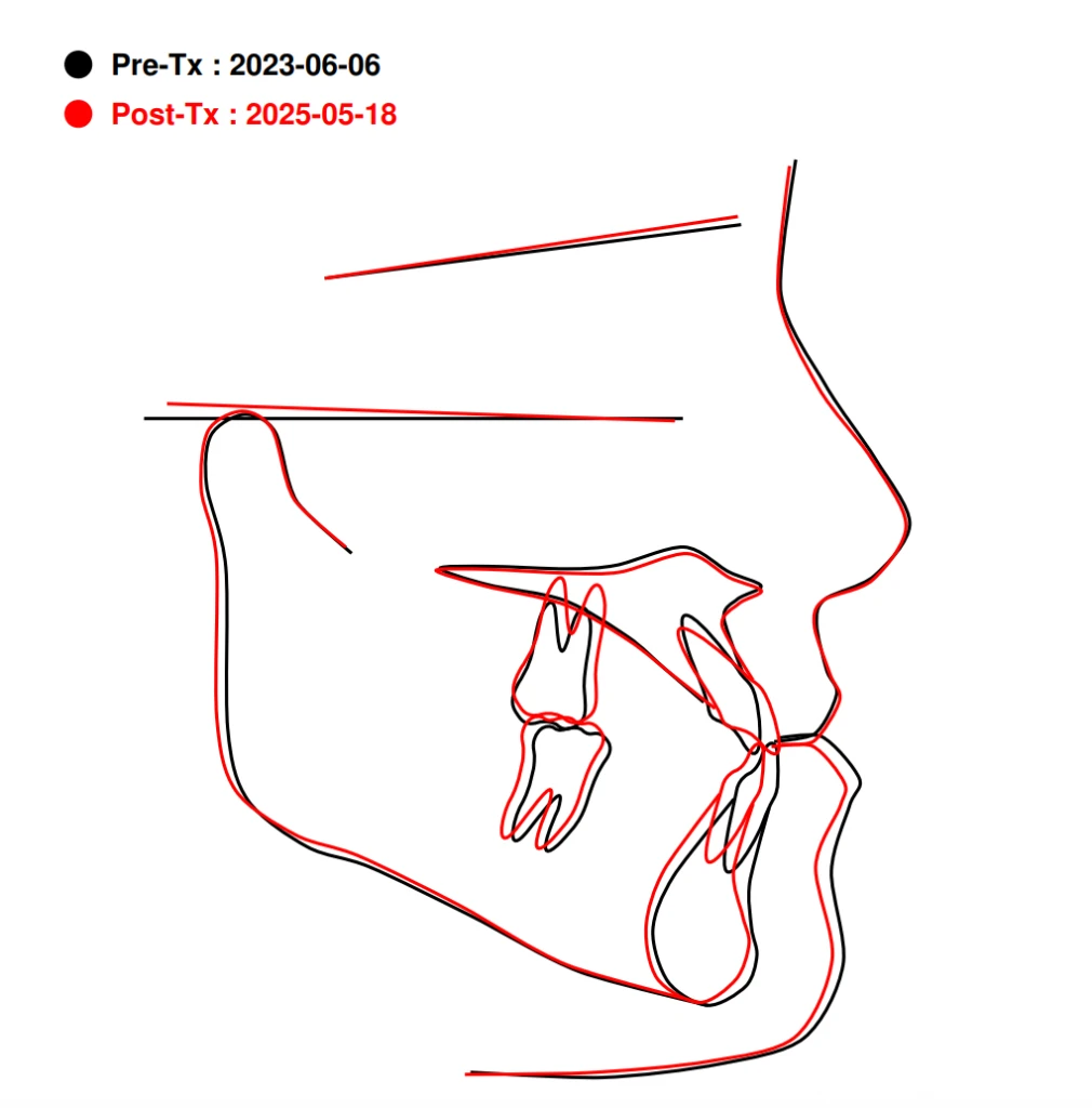 和光市　歯医者　矯正歯科　セファロ重ね合わせ
