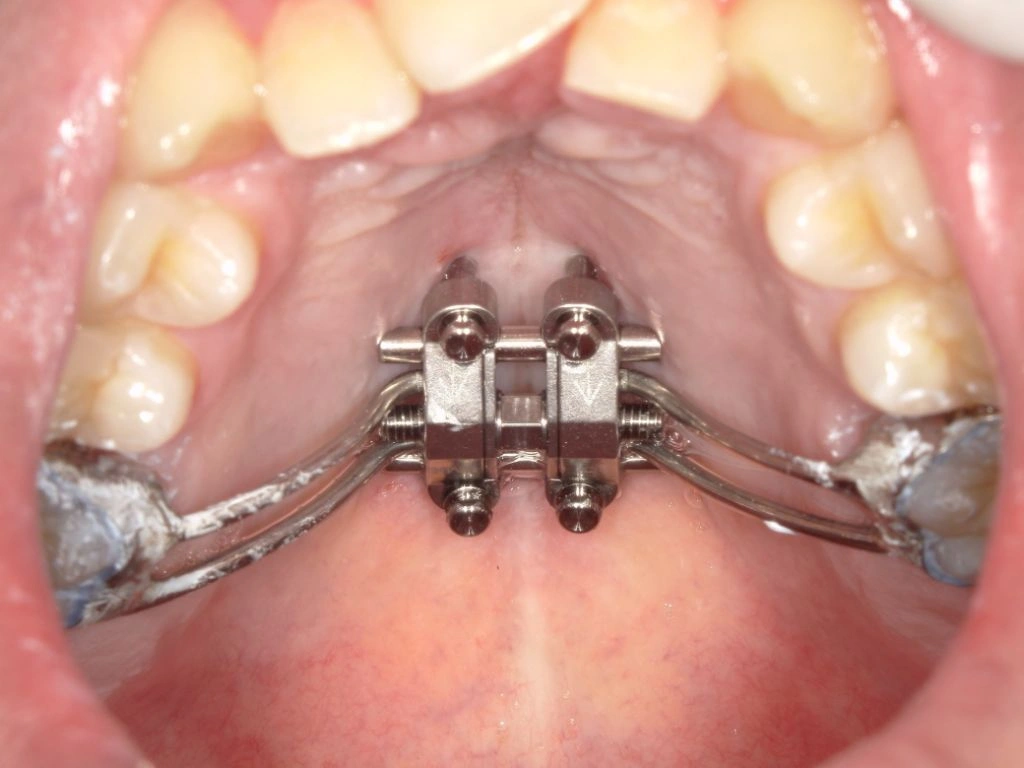 和光市　歯医者　矯正歯科　MSE