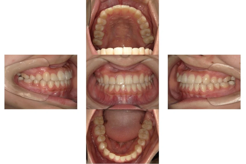 和光市　歯医者　矯正歯科　MSE