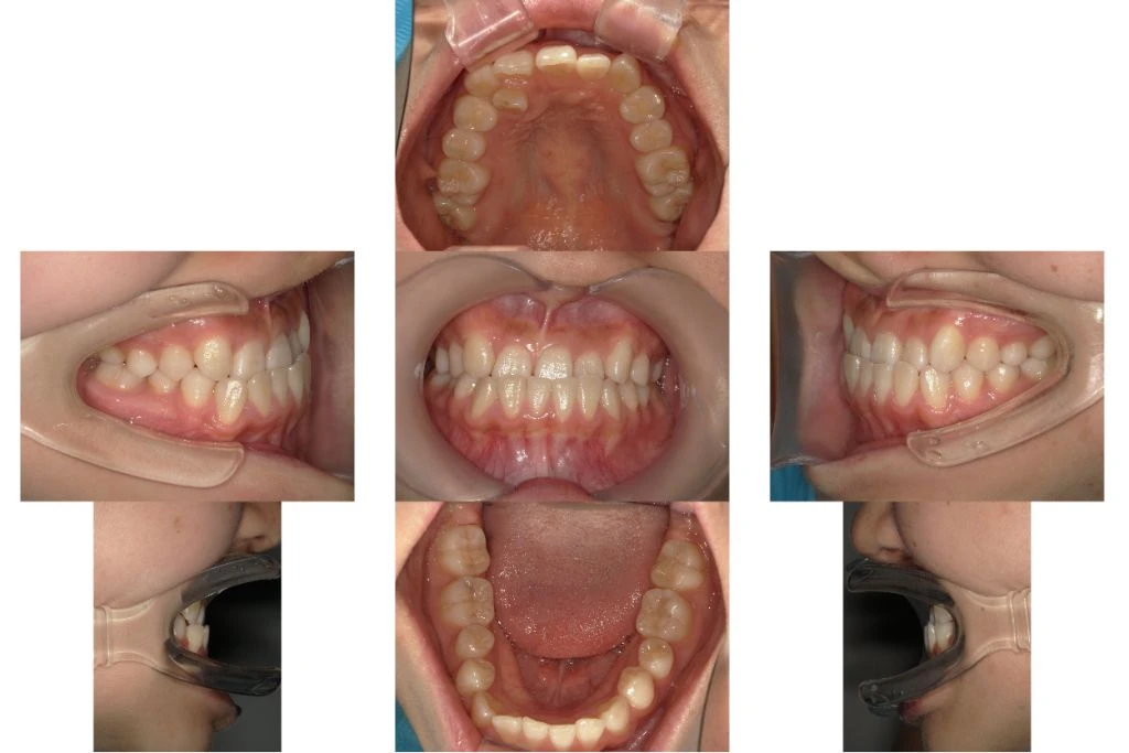 和光市　歯医者　矯正歯科　MSE