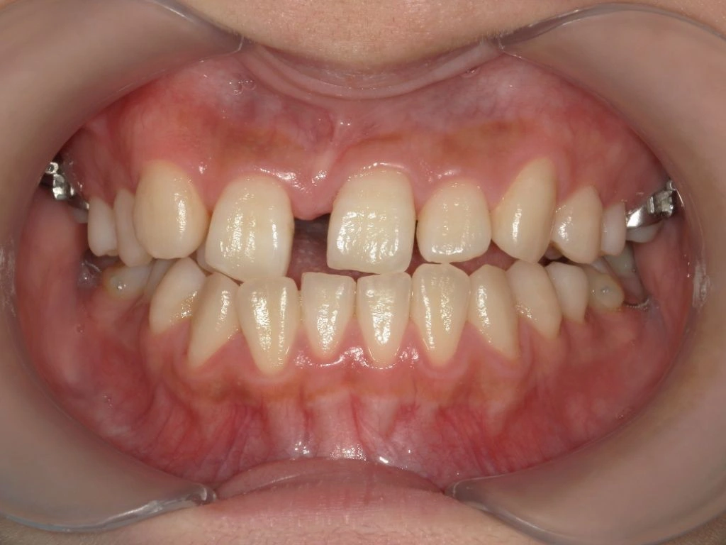 和光市　歯医者　矯正歯科　MSE