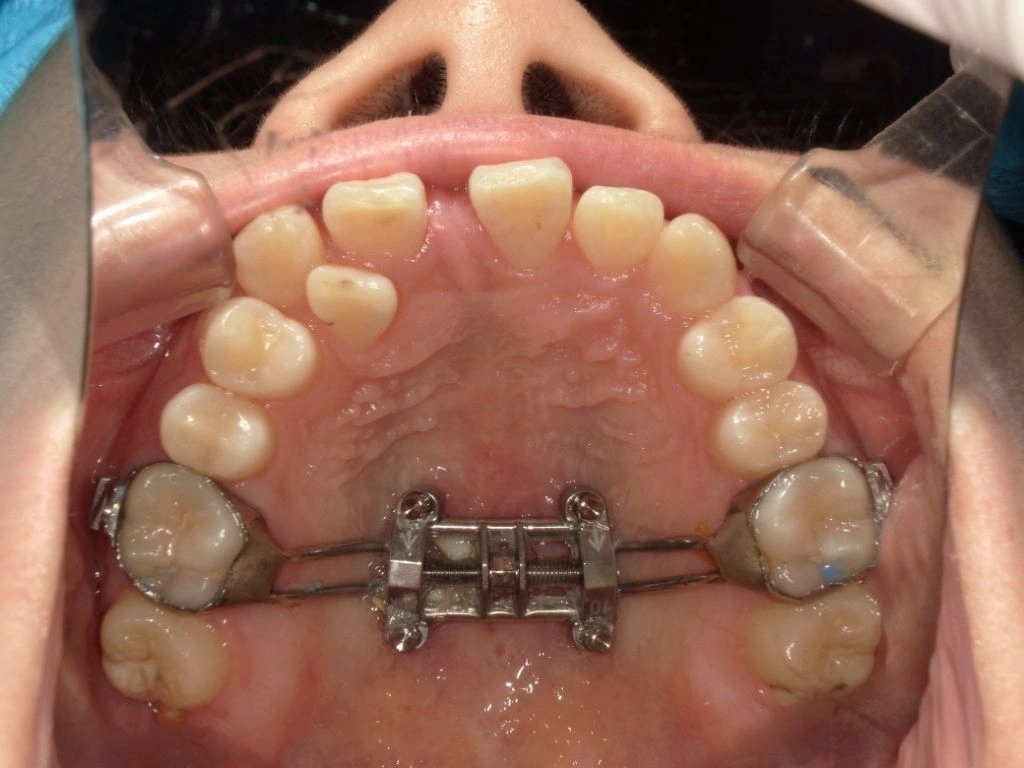 和光市　歯医者　矯正歯科　MSE