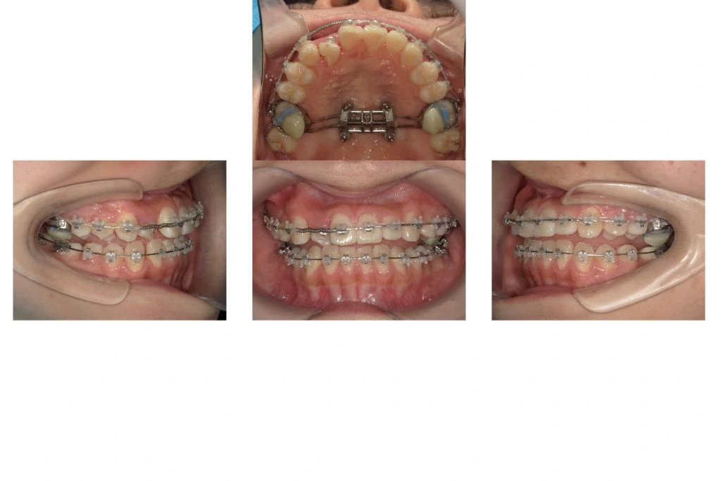 和光市　歯医者　矯正歯科　MSE