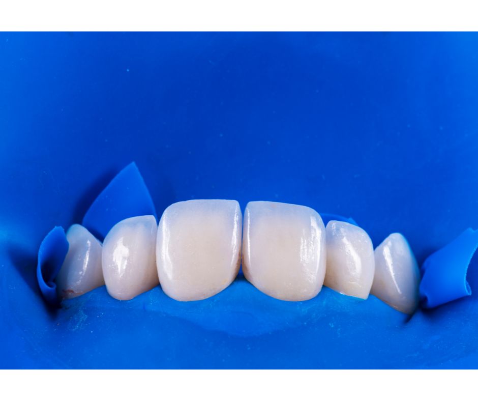 和光市 歯医者 和光市デンタルオフィス 白濁 ホワイトスポット icon治療