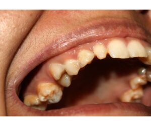 和光市　歯医者　和光市デンタルオフィス 白濁　ホワイトスポット　icon治療