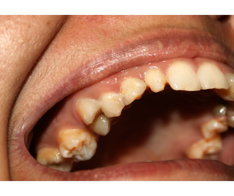 和光市 歯医者 和光市デンタルオフィス 白濁 ホワイトスポット icon治療